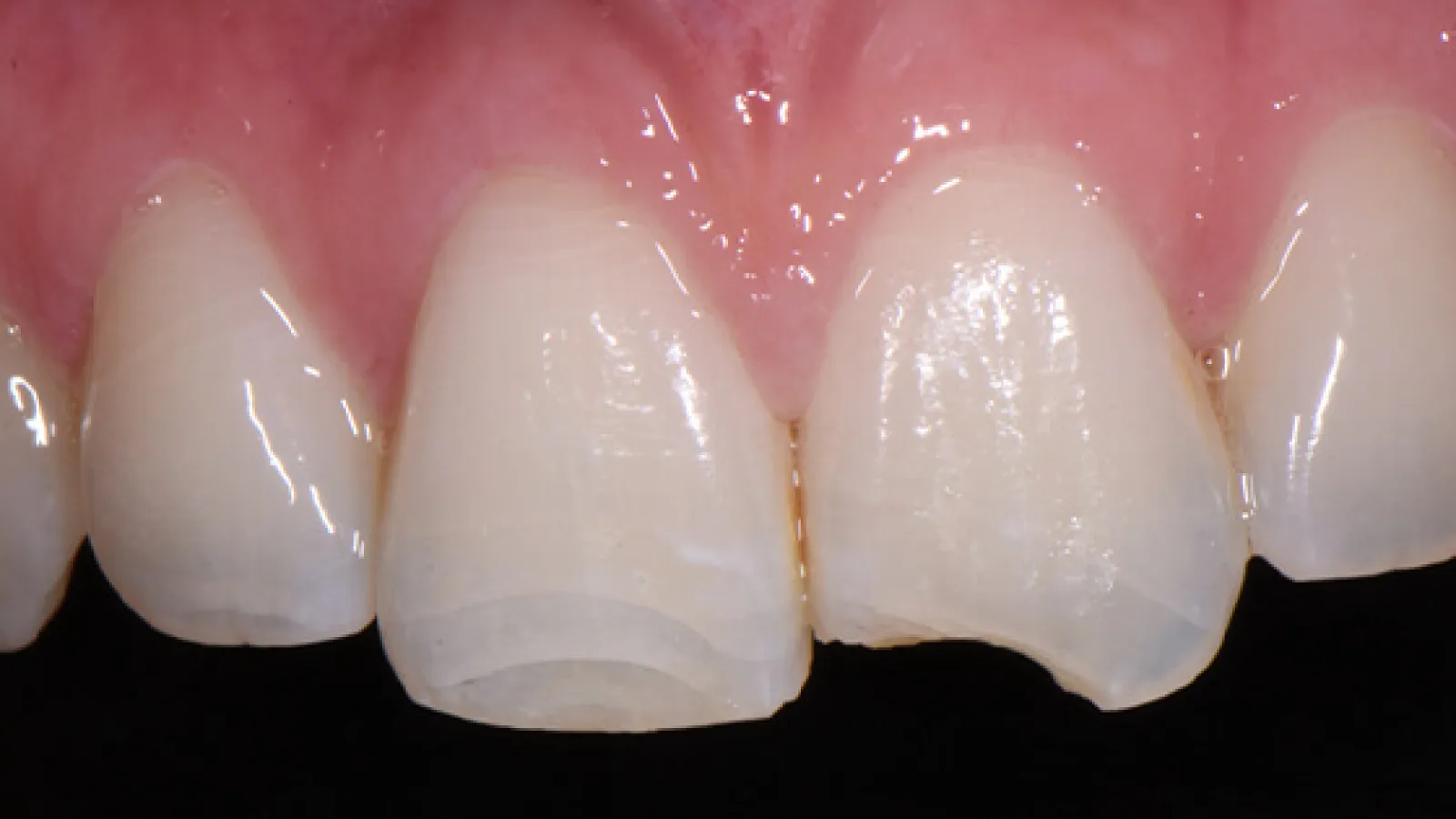 Close-up of upper front teeth with mild enamel wear and a small chip on one tooth.