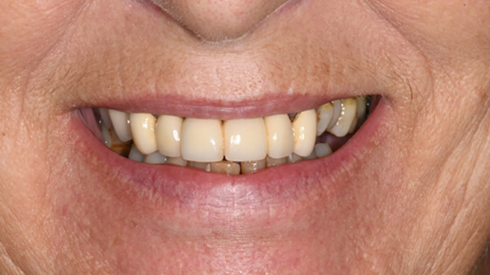 Close-up of an elderly person's mouth showing stained and discolored teeth with dental crowns.