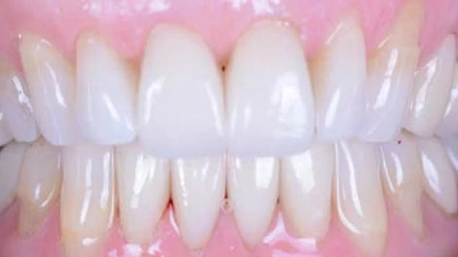 Close-up of clean, healthy teeth with natural gums and bright white enamel, showing full smile alignment.