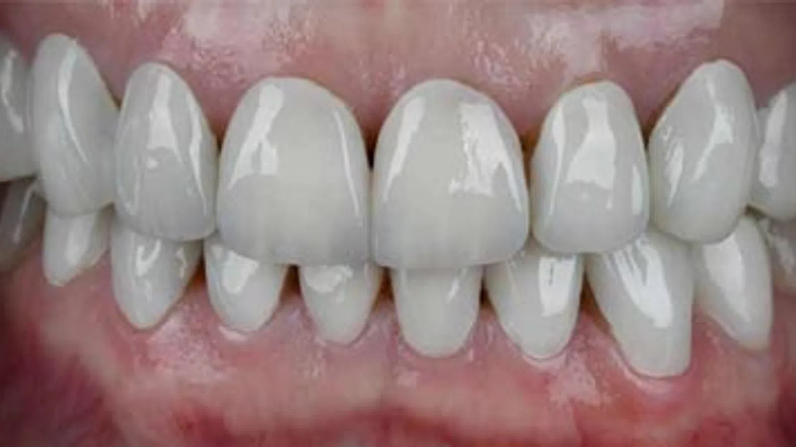 Close-up of healthy white teeth and gums showing dental alignment and natural texture under bright lighting.