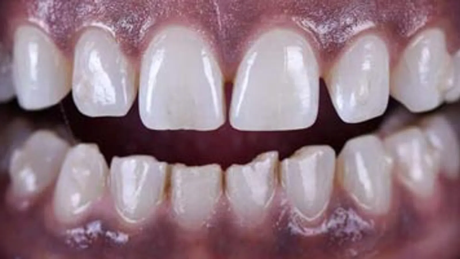 Close-up of a person's teeth showing missing and misaligned lower front teeth with healthy gums.