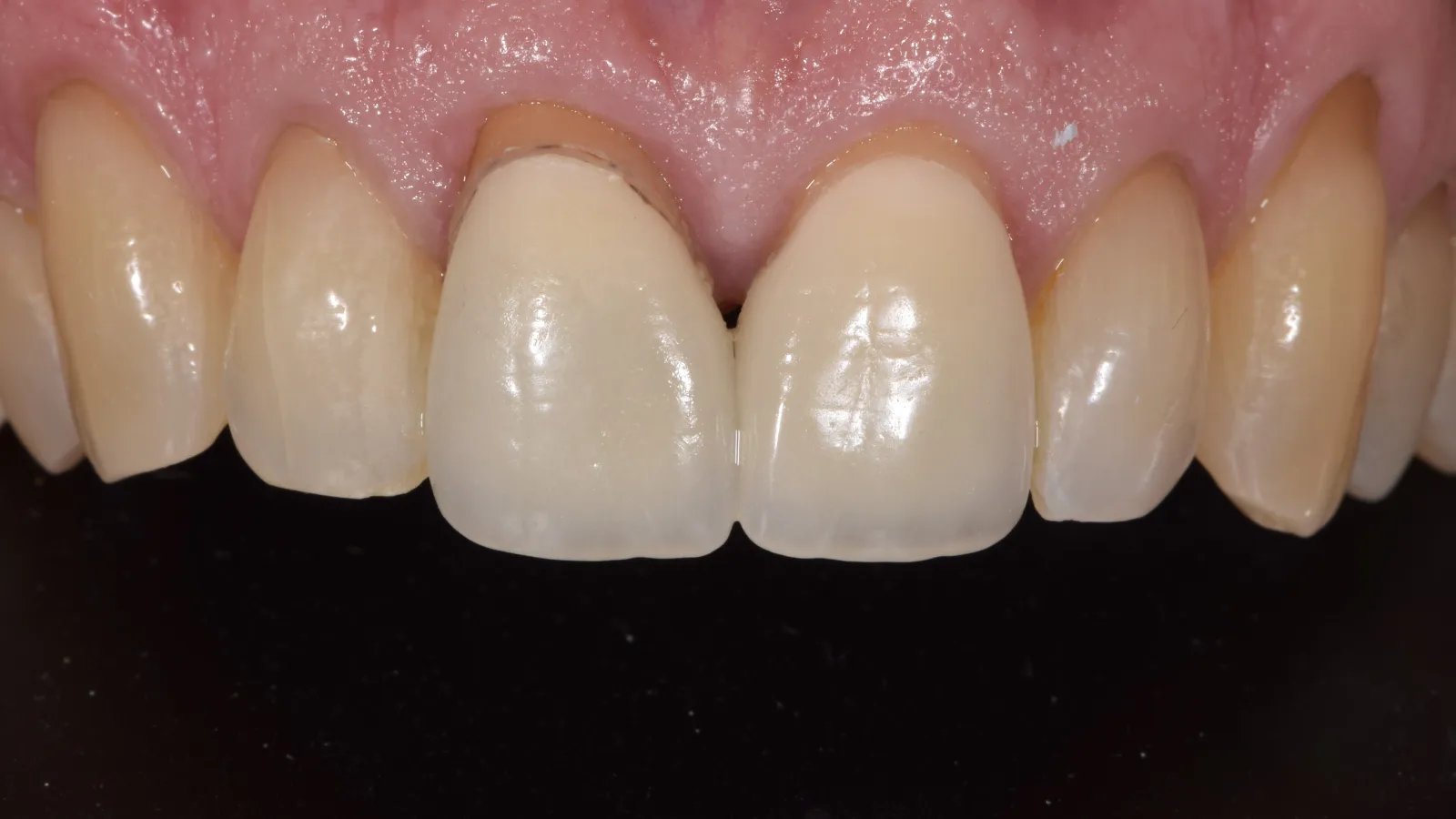 Close-up image of upper front teeth showing dental crowns with natural gums in focus under bright lighting.