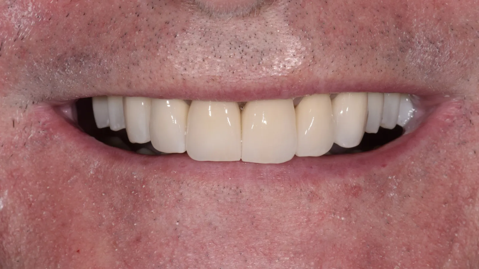 Close-up of a person's smile showing dental crowns or veneers on front teeth with natural skin texture visible.