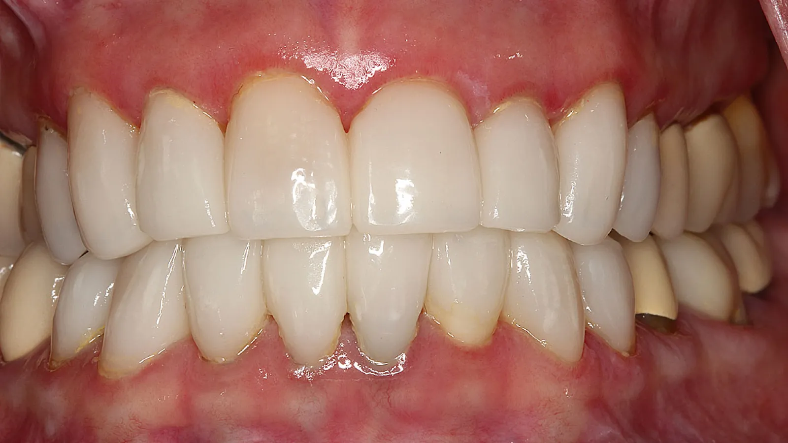 Close-up of a full set of upper and lower human teeth with healthy gums and natural color.