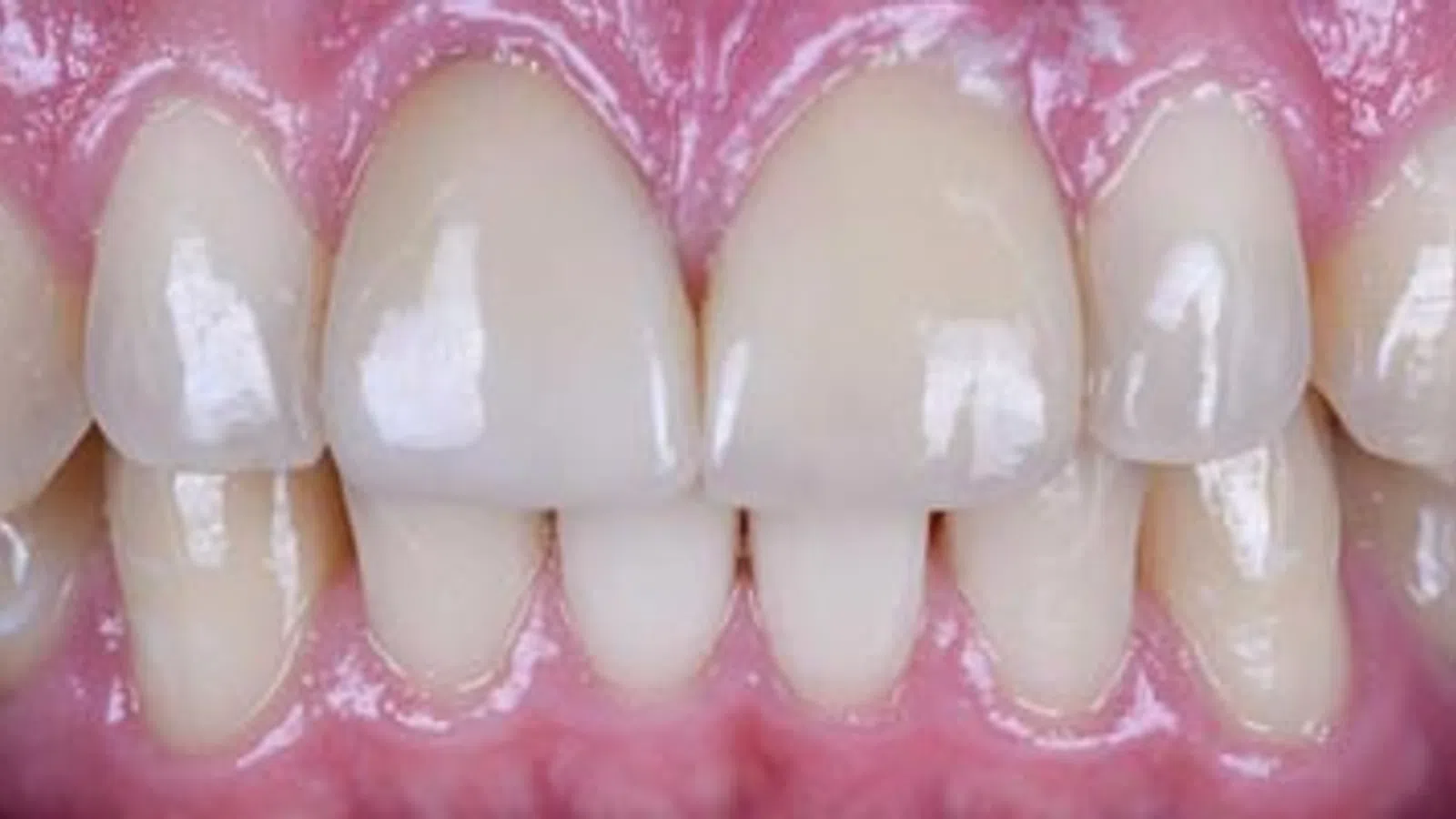 Close-up of upper and lower front teeth with visible gum tissue and dental spacing irregularities.