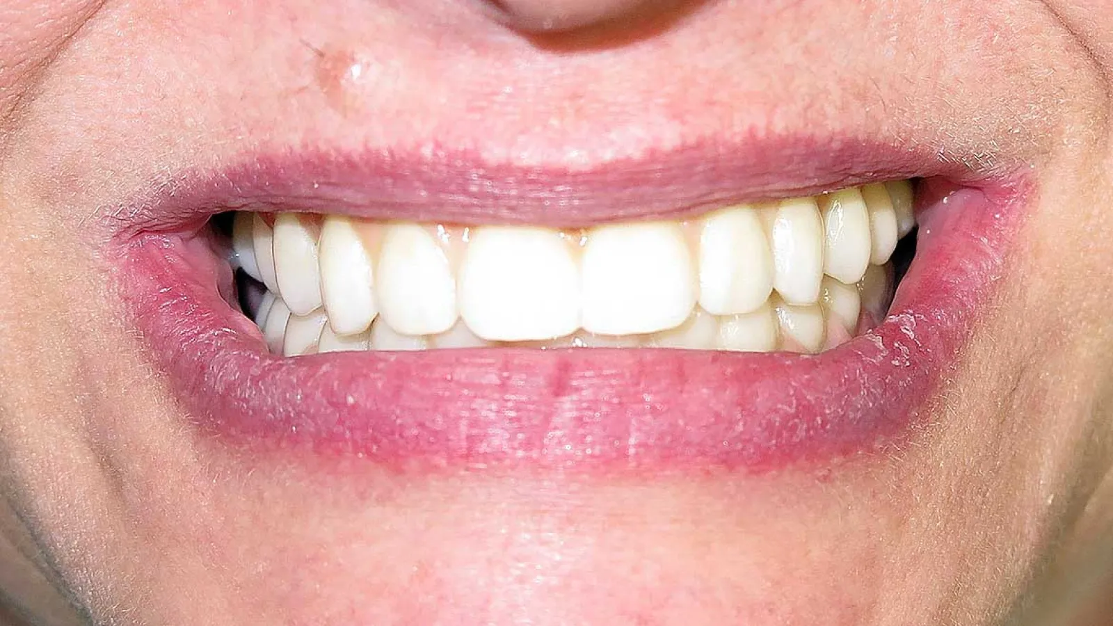 Close-up of a smiling mouth showing clean, white teeth and natural pink lips.