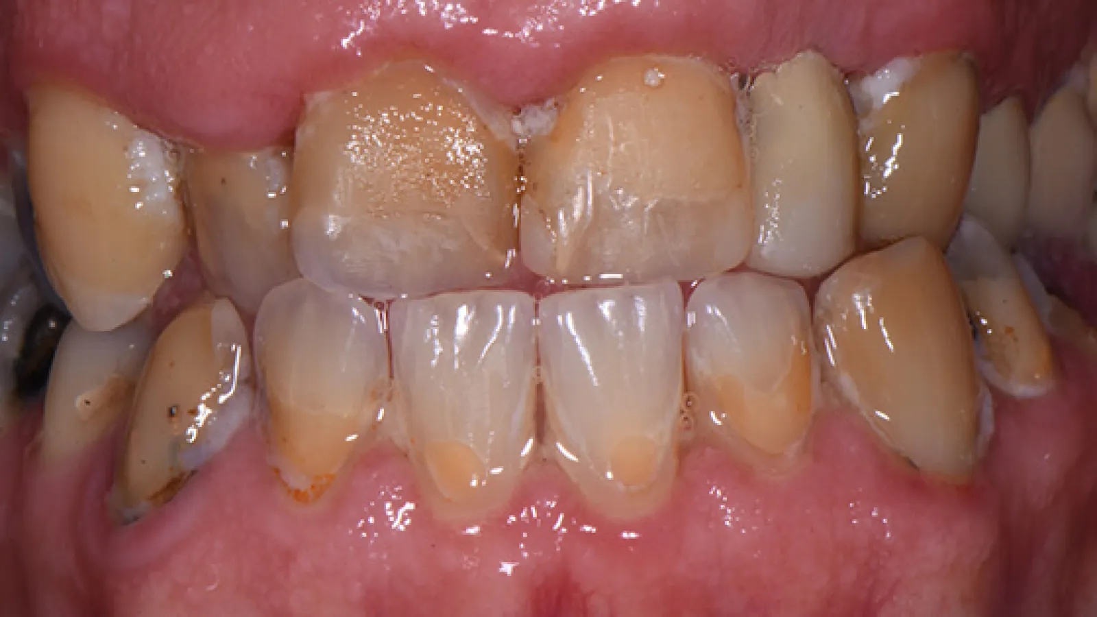 Close-up of teeth showing severe dental plaque, tartar buildup, and gum inflammation.
