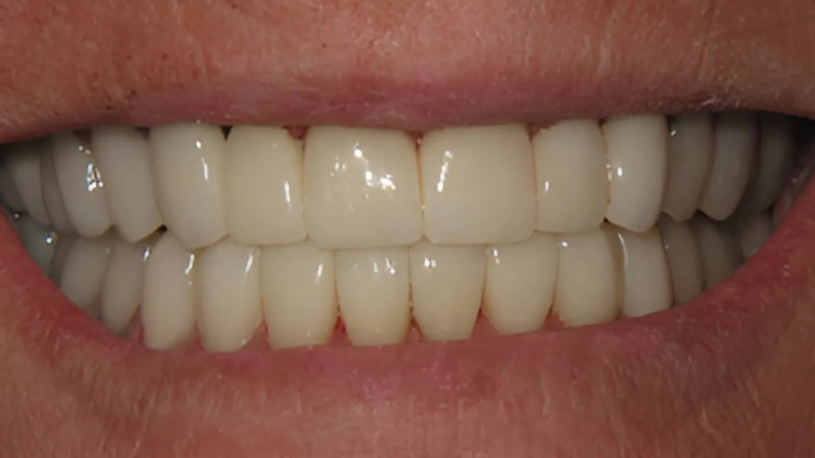 Close-up of a smiling mouth showing clean, white, evenly aligned teeth with healthy gums.