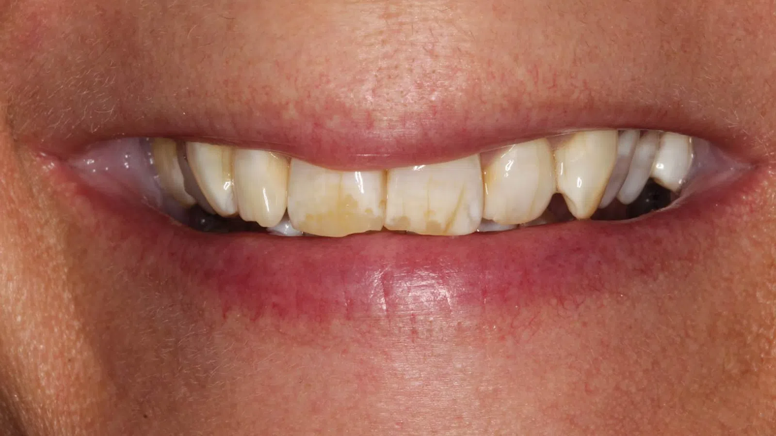 Close-up of a smile showing stained and misaligned upper teeth with visible dental plaque.