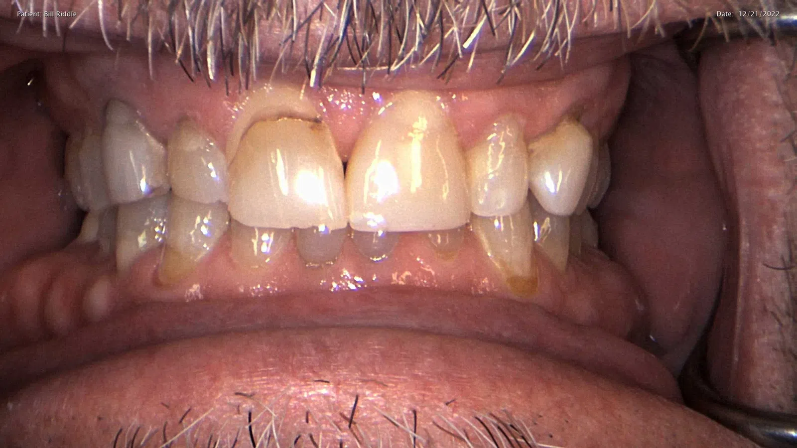 Close-up of male mouth showing cracked, discolored, and uneven upper front teeth with facial hair.