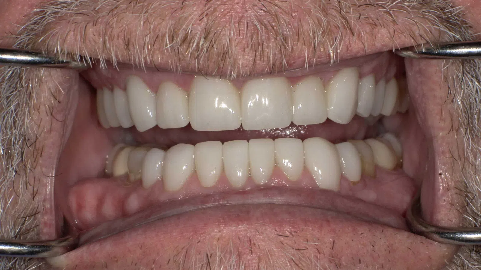 Close-up of an elderly man's mouth with dental retractors showing upper and lower teeth and gums