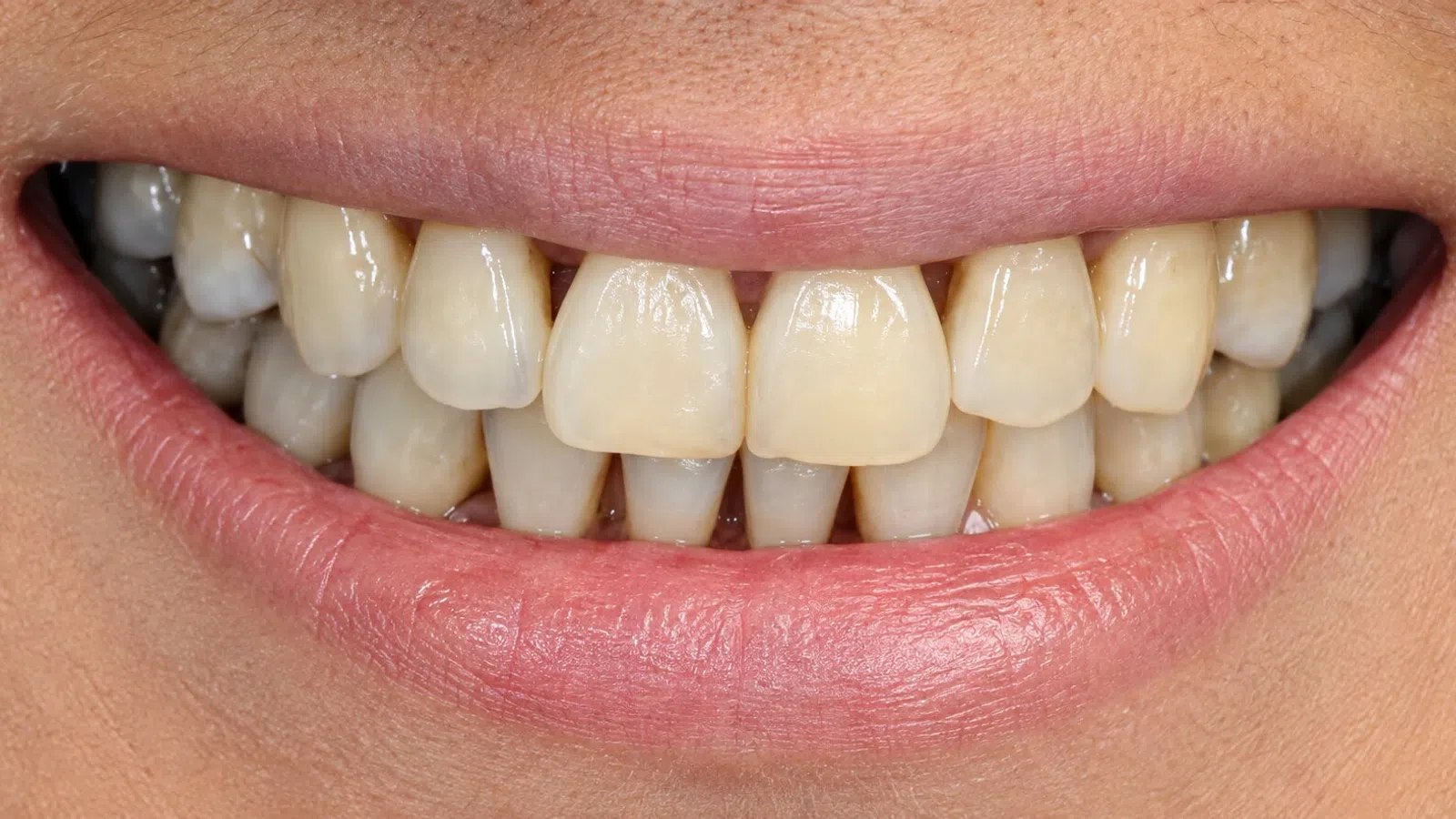 Close-up of a smiling mouth showing slightly yellow and misaligned teeth and natural lips.