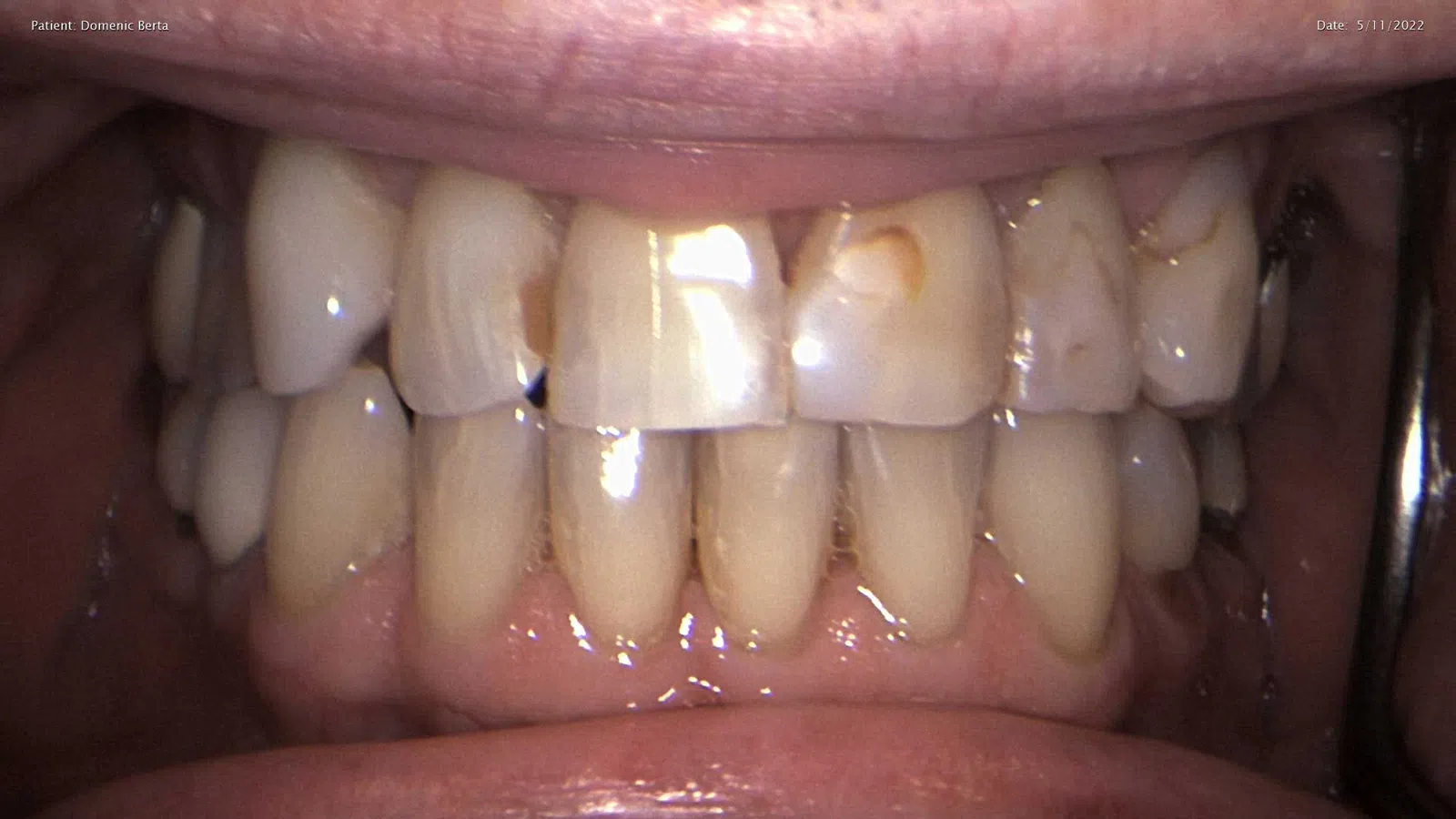 Close-up of teeth showing dental decay and discoloration on upper front teeth.