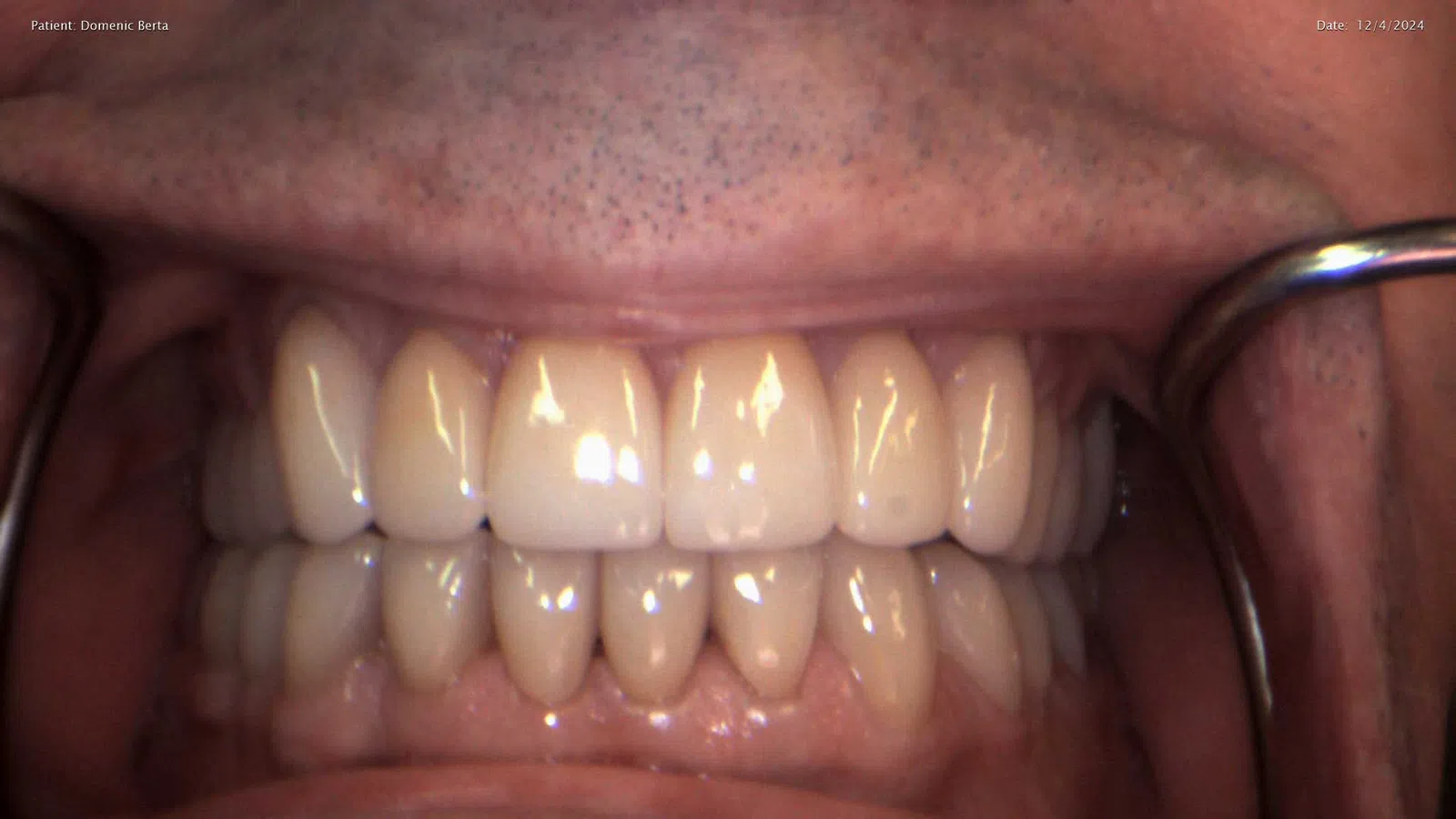Close-up of a dental patient's mouth showing clean, healthy upper and lower teeth with dental tools on sides.