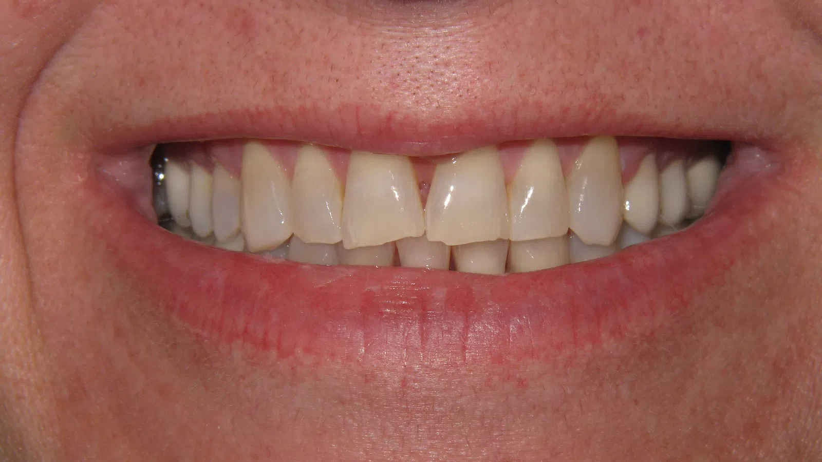 Close-up of a person's smile showing natural teeth with slight discoloration and minor gaps between front teeth.