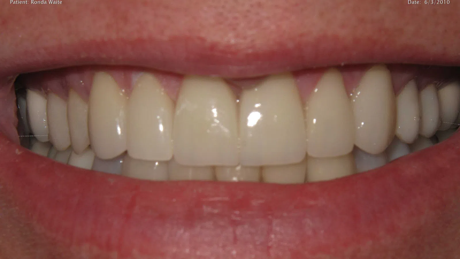 Close-up of a smiling mouth showing clean, straight, and white teeth with healthy gums.