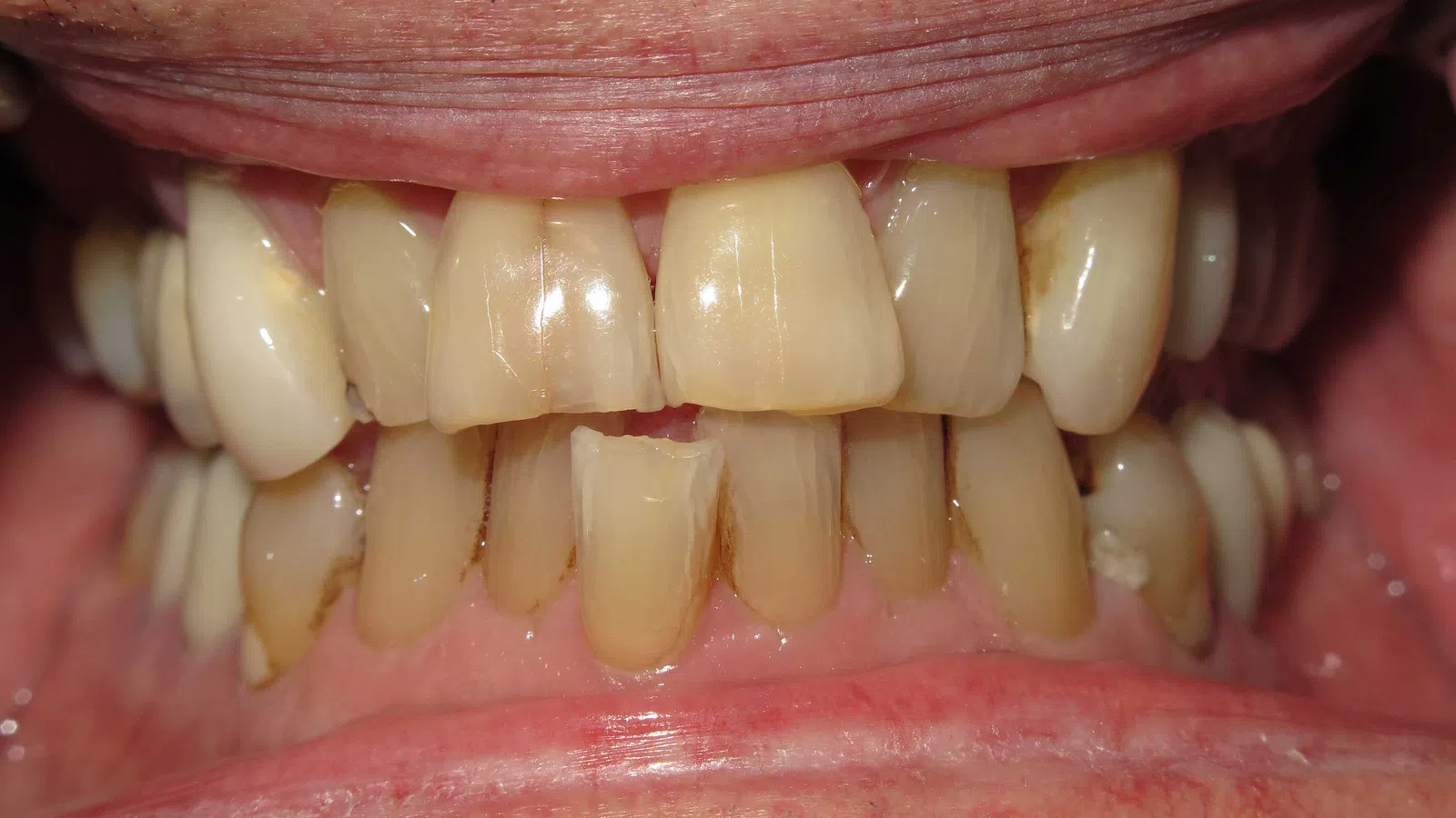 Close-up of stained and damaged teeth with gaps and discoloration in an adult mouth.