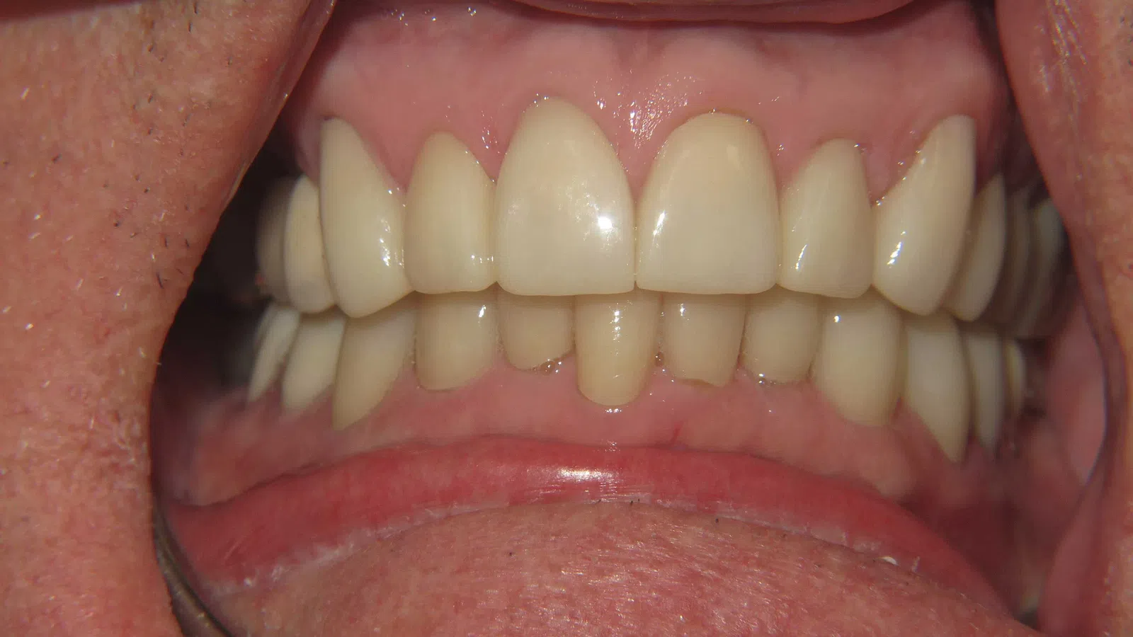 Close-up of a person's mouth showing clean, well-aligned upper and lower teeth with dental retractors.