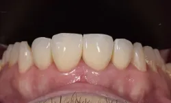 Thumbnail control image for Close-up of upper front teeth and pink gums with visible natural texture and healthy appearance.