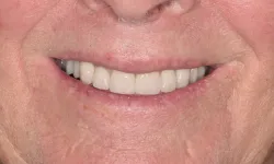 Thumbnail control image for Close-up of a smiling older person with well-aligned white teeth and visible skin texture around the mouth.