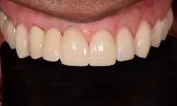 Thumbnail control image for Close-up of upper front teeth and gums showing natural teeth coloration and healthy pink gums.
