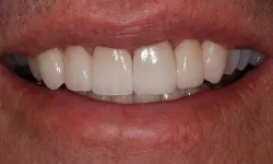 Thumbnail control image for Close-up of a smile showing clean, well-aligned white teeth and lips with natural texture.