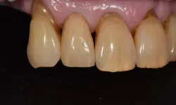 Thumbnail control image for Close-up of upper front teeth with visible plaque, staining, and gum recession against a black background.