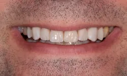 Thumbnail control image for Close-up of a man's smile showing clean, white teeth and facial stubble on lips and chin.