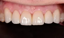 Thumbnail control image for Close-up of clean, healthy upper front teeth and gums with natural shine and no visible dental issues.