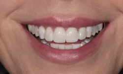 Thumbnail control image for Close-up of a smiling mouth showing clean, white teeth with natural lips and skin texture.
