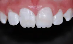 Thumbnail control image for Close-up of upper front teeth showing slight white discoloration and healthy pink gums.