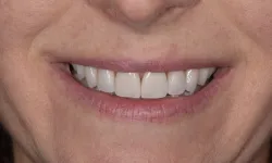 Thumbnail control image for Close-up of a smiling mouth showing clean, white teeth and natural lips on a light skin tone.