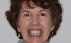 Thumbnail control image for Close-up of a middle-aged woman smiling, showing natural teeth and wearing silver earrings.