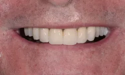 Thumbnail control image for Close-up of a man's mouth showing dental veneers or crowns on upper front teeth.