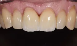 Thumbnail control image for Close-up of upper front teeth with healthy gums and natural enamel texture.