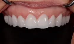 Thumbnail control image for Close-up of well-aligned, clean, and bright upper front teeth with healthy gums and dental retractors.