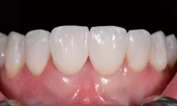 Thumbnail control image for Close-up of clean, white front teeth and healthy pink gums with dental tools on sides.