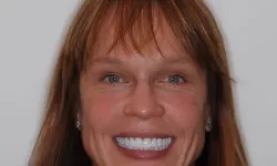 Thumbnail control image for Close-up of a smiling woman with light brown hair and bright white teeth against a plain background