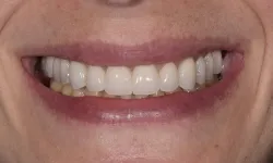 Thumbnail control image for Close-up of a smiling mouth showing clean, white, evenly aligned teeth and healthy lips.