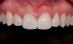 Thumbnail control image for Close-up of upper front teeth and gums showing healthy enamel and pink gum tissue against black background.