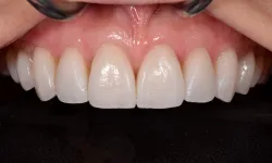 Thumbnail control image for Close-up of healthy, clean upper front teeth and gums with a dental tool keeping lips open