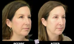Thumbnail control image for Best Brow lift Case Study 6 Atlanta Facial Aesthetic Surgery