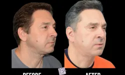 Thumbnail control image for Best Chin Liposuction & Tightening Before & After Case Study 8