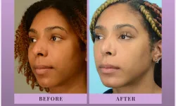 Thumbnail control image for Best Chin Implant Atlanta Case Study 4 Facial Aesthetic Surgery