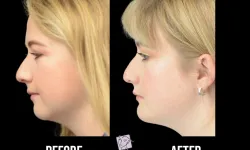 Thumbnail control image for Best Chin Liposuction & Tightening Before & After Case Study 4