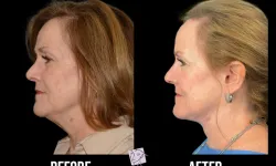 Thumbnail control image for Best Necklift Case Study 2 Facial Aesthetic Surgery