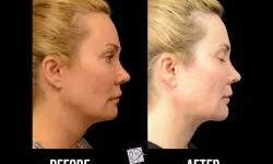 Thumbnail control image for Best Chin Liposuction & Tightening Before & After Case Study 2
