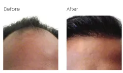 Thumbnail control image for Atlana Hair Transplant