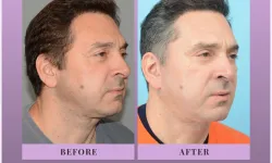 Thumbnail control image for Best Necklift Case Study 4 Facial Aesthetic Surgery