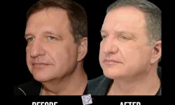 Thumbnail control image for Best Facelift Atlanta Case Study 10 Facial Aesthetic Surgery